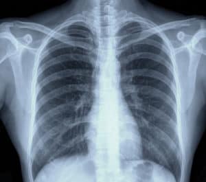chest x-ray