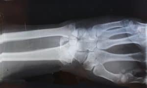 wrist x-ray image