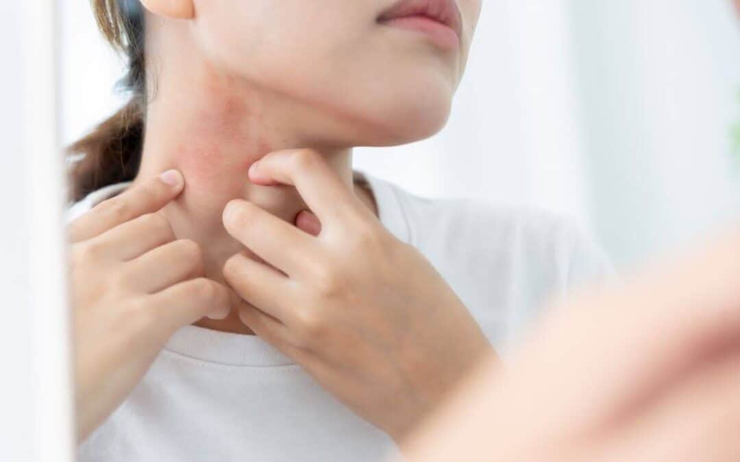 Skin Health Alert: When Hives and Rashes Signal a Deeper Issue