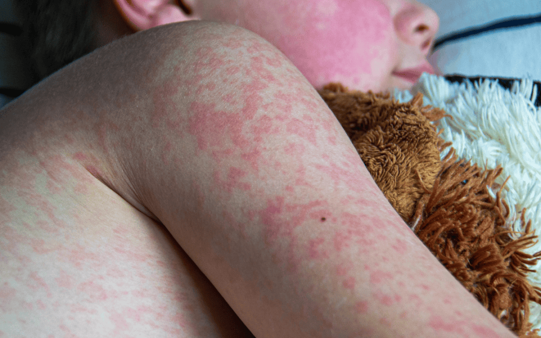 Back to School, Back to Sickness: Managing Fall Viruses